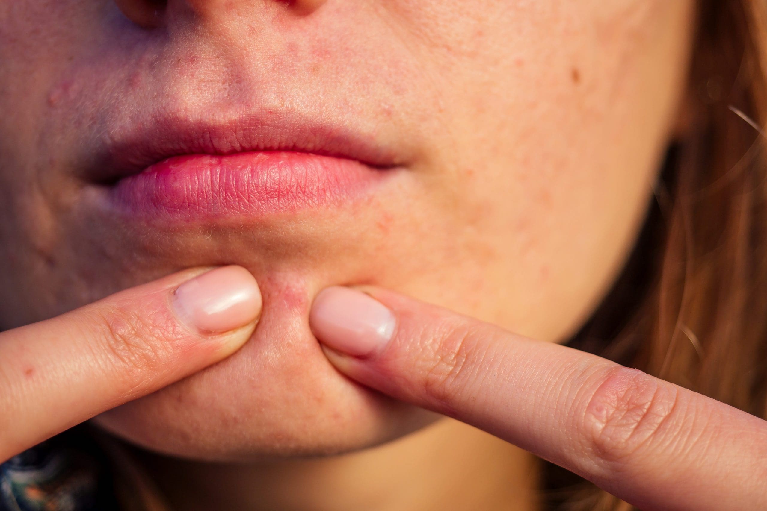 A Naturopathic Approach to Acne