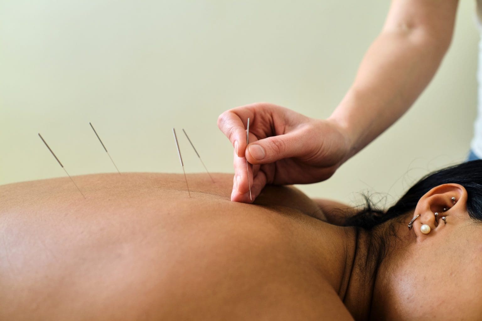 Woman receiving acupuncture treatment for migraine. Naturopathy Naturopathic
